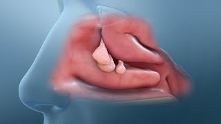 Nasal Polyp Removal Surgery [upl. by Harriett942]