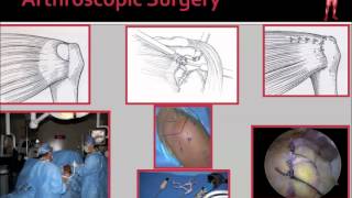 Arthroscopic Rotator Cuff Repair Surgery [upl. by Guod]