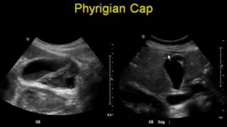 Errors in Gallbladder Ultrasound [upl. by Hervey]