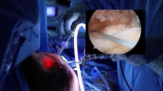 Rotator Cuff Repair Surgical Technique [upl. by Yregram468]