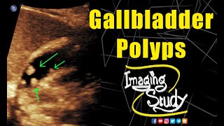 Gallbladder Polyps  Ultrasound  Case 136 [upl. by Forras917]