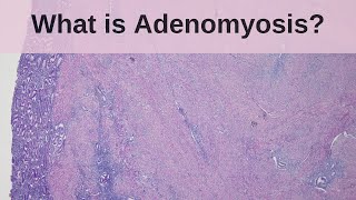 What is Adenomyosis  Pathology mini tutorial [upl. by Ainahs496]