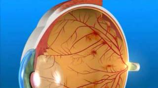 Diabetic Eye Disease PDR Laser Surgery [upl. by Atilamrac]