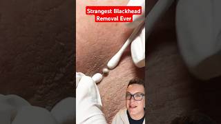 Strangest BLACKHEAD REMOVAL Ever  What Is This shorts [upl. by Uba]