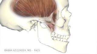 Temporalis Tendon Transfer  Facial Paralysis Surgery [upl. by Aitercul]