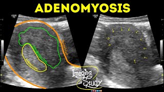 Adenomyosis  Ultrasound  Case 42 [upl. by Anivle334]