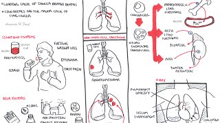 Lung Cancer  Overview [upl. by Eiltan]