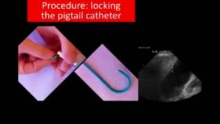 Ultrasound Guided Drainage of the Gallbladder [upl. by Marinelli263]