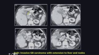 Correlative Imaging of Gallbladder Cancer How to Differentiate From Acute Cholecystitis [upl. by Ecirtak]