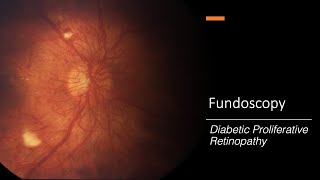 Proliferative Diabetic Retinopathy Treatment  Vitrectomy Surgery [upl. by Brock]