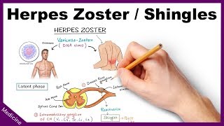 Herpes ZosterShingles Symptoms Diagnosis Treatment [upl. by Jaeger]