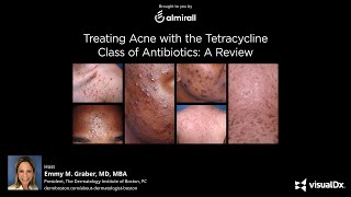 Treating Acne with the Tetracycline Class of Antibiotics A Review [upl. by Melan]