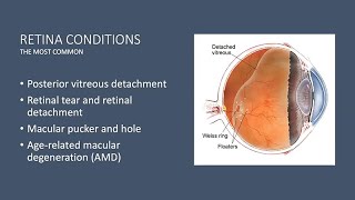 Proliferative Diabetic Retinopathy PDR [upl. by Nosreg876]