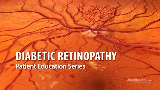 Proliferative Diabetic Retinopathy Treatment  PRP Laser [upl. by Nnad]