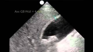 How To Gallbladder Ultrasound Part 3  Acute Cholecystitis Case Study Video [upl. by Rubi158]