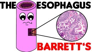 Esophagus Histology  3 Barretts Esophagus [upl. by Hailee]