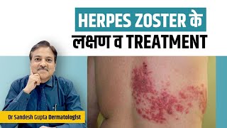 What is Herpes – Types of Herpes amp Remedies Covered by DrBerg [upl. by Caughey280]