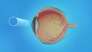 Demystifying Retinal Diseases [upl. by Anita]