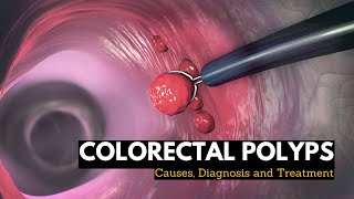 Colorectal Polyps Causes Signs and Symptoms Diagnosis and Treatment [upl. by Enelyahs]