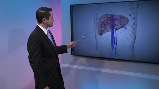 Liver Cancer Staging [upl. by Neenad]