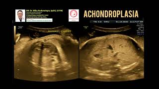 Achondroplasia [upl. by Swanson624]