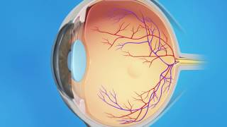 Classification of Diabetic Retinopathy [upl. by Doug514]