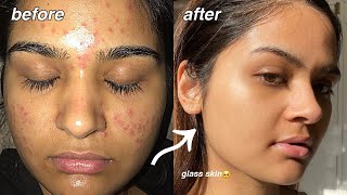 how i cleared my acne FOR GOOD something finally worked [upl. by Enuj]