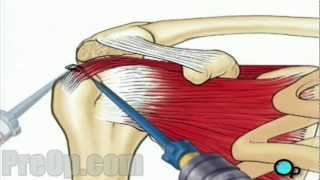 10 Best Rotator Cuff Exercises Beginner to Advanced Strengthening [upl. by Orfield]