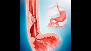 Diseases of the esophagus part 1 by ASM Minds [upl. by Rosenfeld]