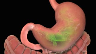 Stomach Ulcer  Nucleus Health [upl. by Otecina]