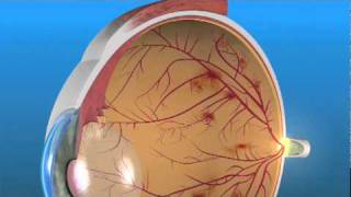 Nonproliferative Diabetic Retinopathy NPDR [upl. by Alyal]