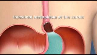 Sinusitis and Sinus Surgery Explained Balloon Sinuplasty and Endoscopic Sinus Surgery [upl. by Edlun]