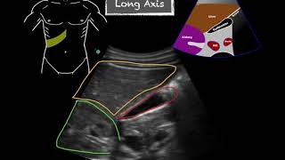 POCUS  Gallbladder Ultrasound Anatomy [upl. by Ohl]