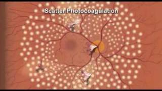 Diabetic retinopathy treatment explained  Ohio State Medical Center [upl. by Atinhoj]