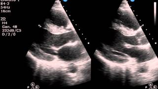 ECOCARDIOGRAMA NORMAL [upl. by Ardie]