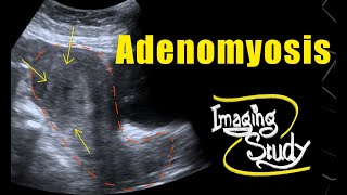 Adenomyosis  Ultrasound  Case 69 [upl. by Moses]