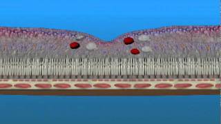 Diabetic Retinopathy Focal Retina Laser FRP treatment workshop by Kanellopoulos MD 2015 [upl. by Gherlein]