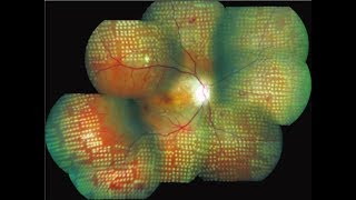 Diabetes 20 Diabetic Retinopathy [upl. by Nil]